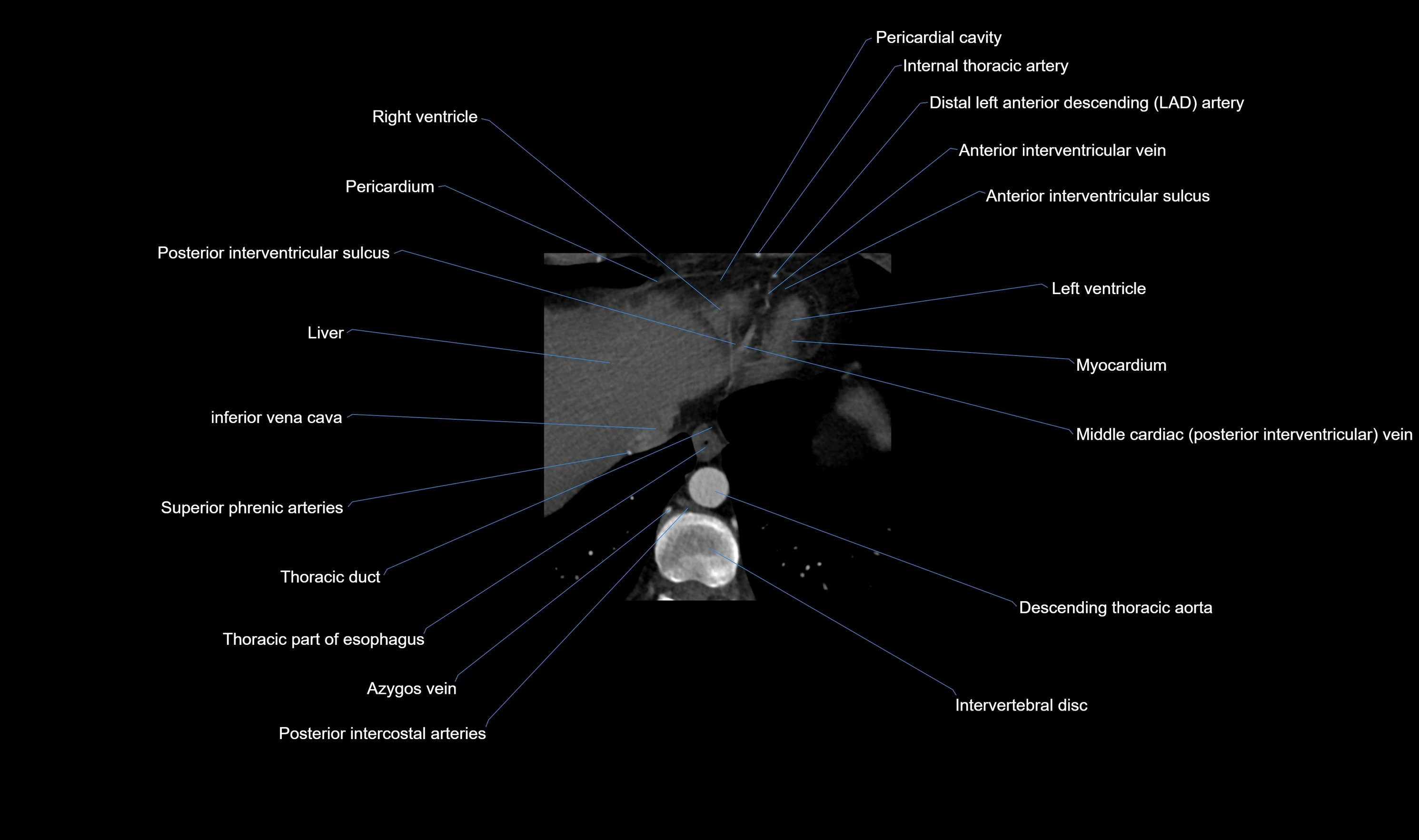 CT heart (coronary angiogram) axial view cross sectional anatomy labelled radiology image-00065.webp